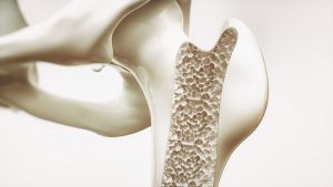 osteoporosis-bone-health